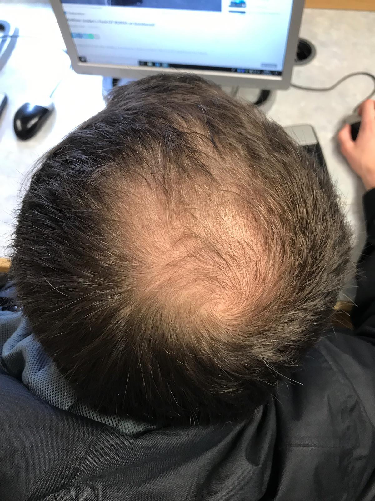 Alopesia Androgenetik